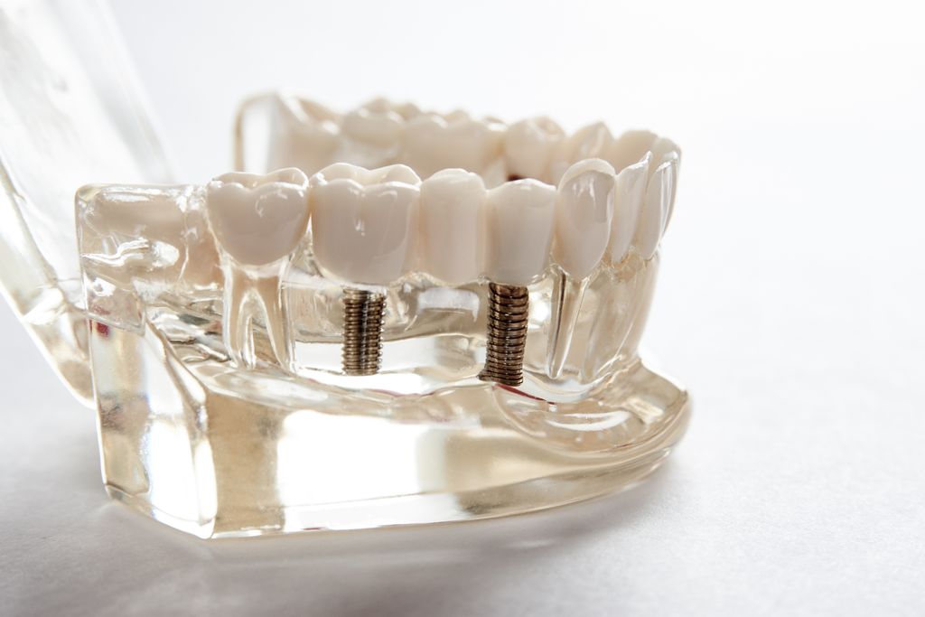 当院のインプラント治療で大切にしていること