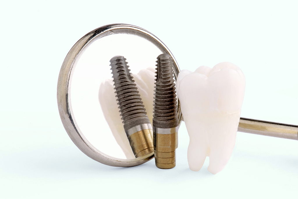 インプラントのメリット