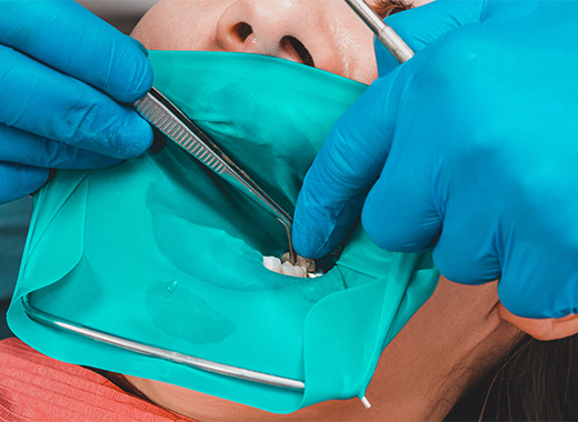  治療前の準備（麻酔・ラバーダム）