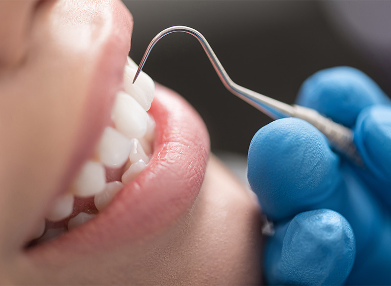 予防・クリーニング